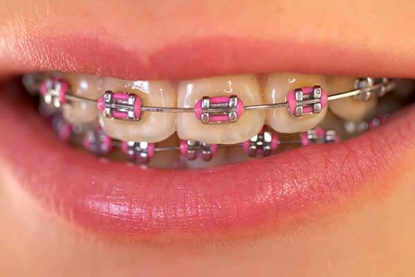 metal braces